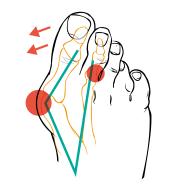 Korekčné ponožky tejpovacie na vbočený palec Compressana TAPE SOX Hallux valgus